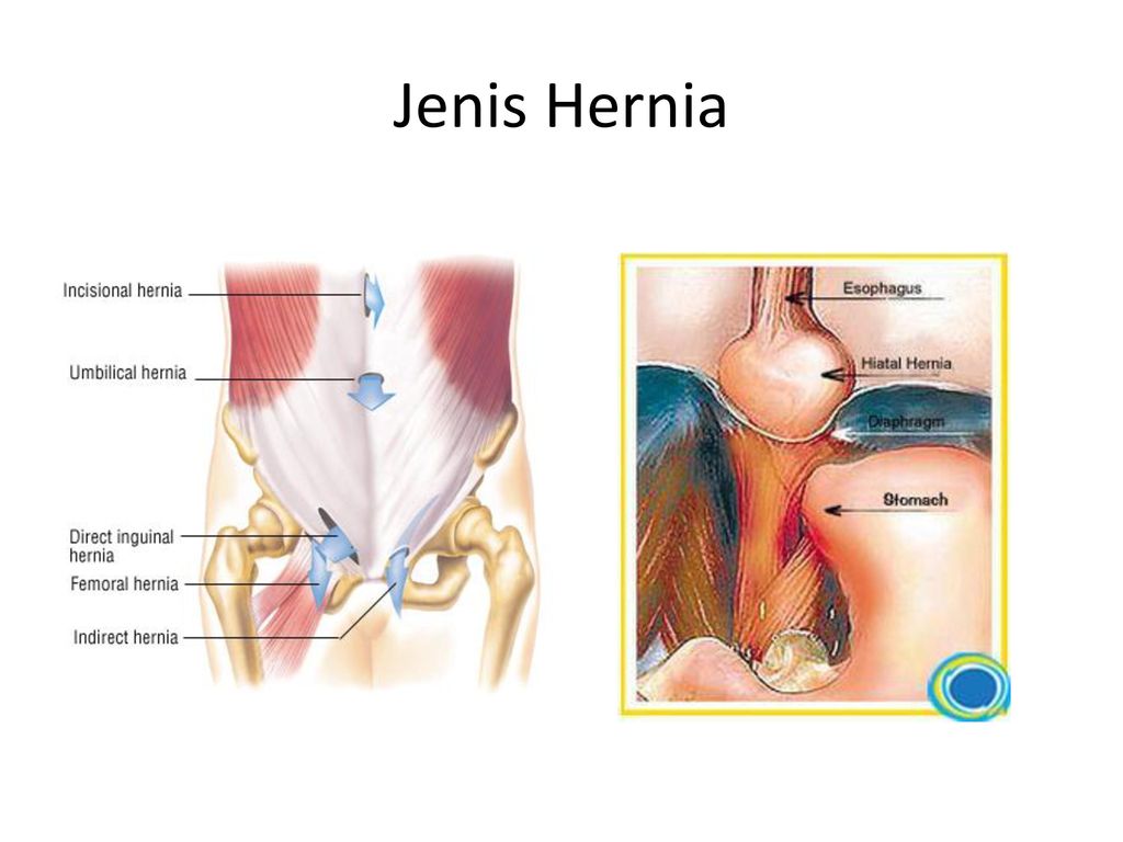 Se puede reproducir una hernia discal operada